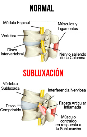 subluxacion-vertebral