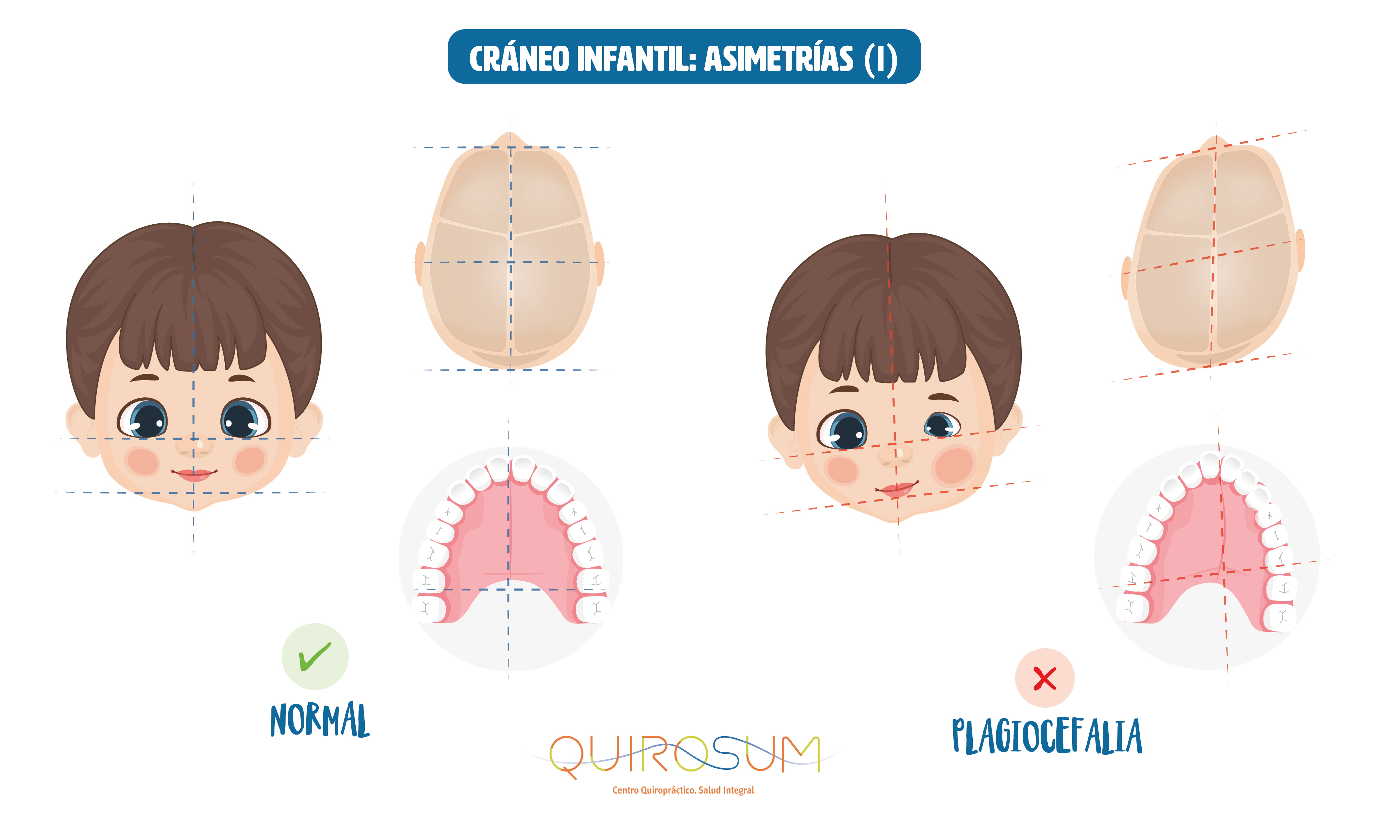 quiropractica-plagiocefalia-bebe